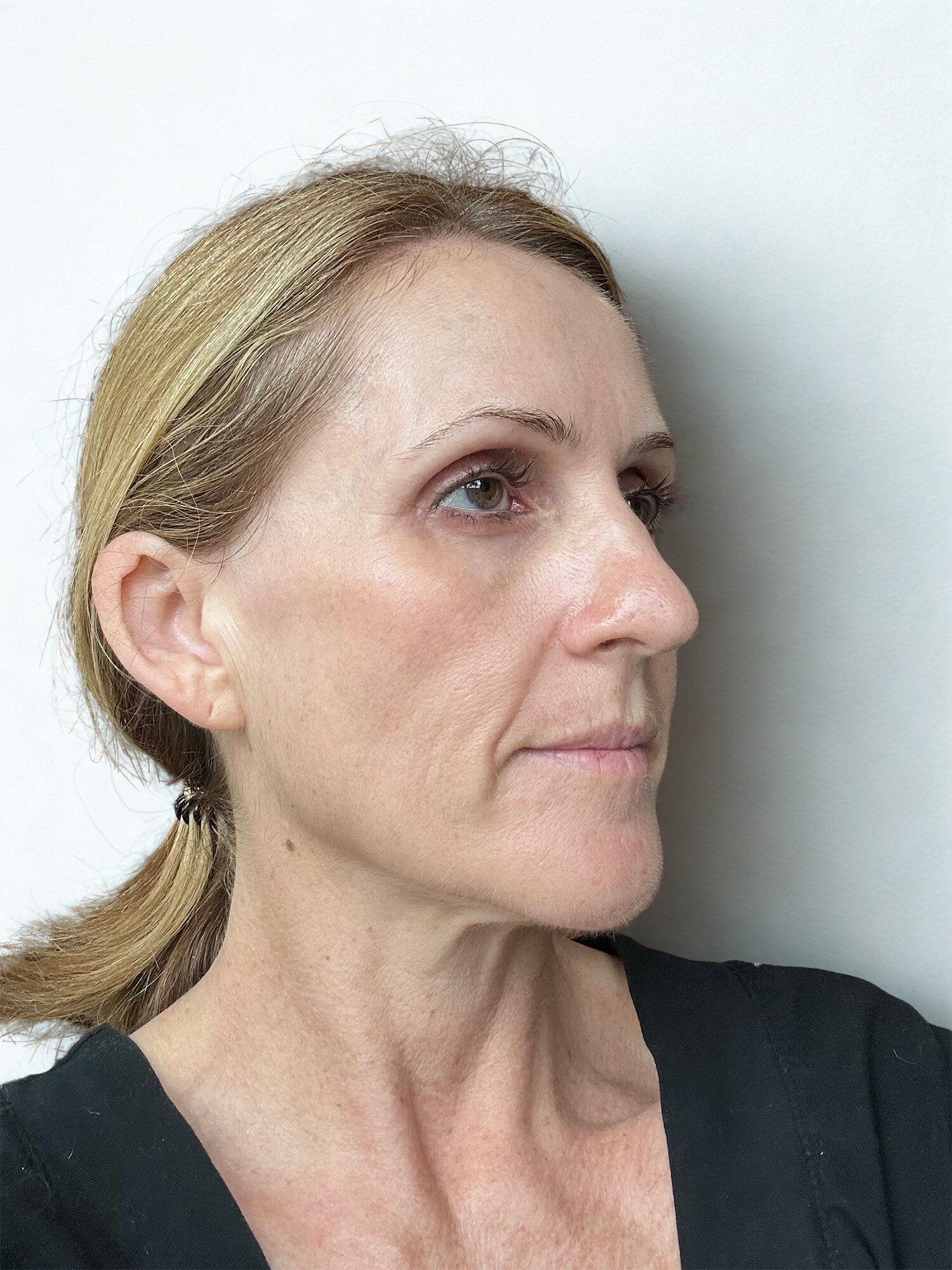 Before Image: Biostimulator Treatment Face (Hyperdilute Radiesse), Clear + Brilliant Laser, Sylfirm X Radiofrequency Microneedling - right-front-oblique