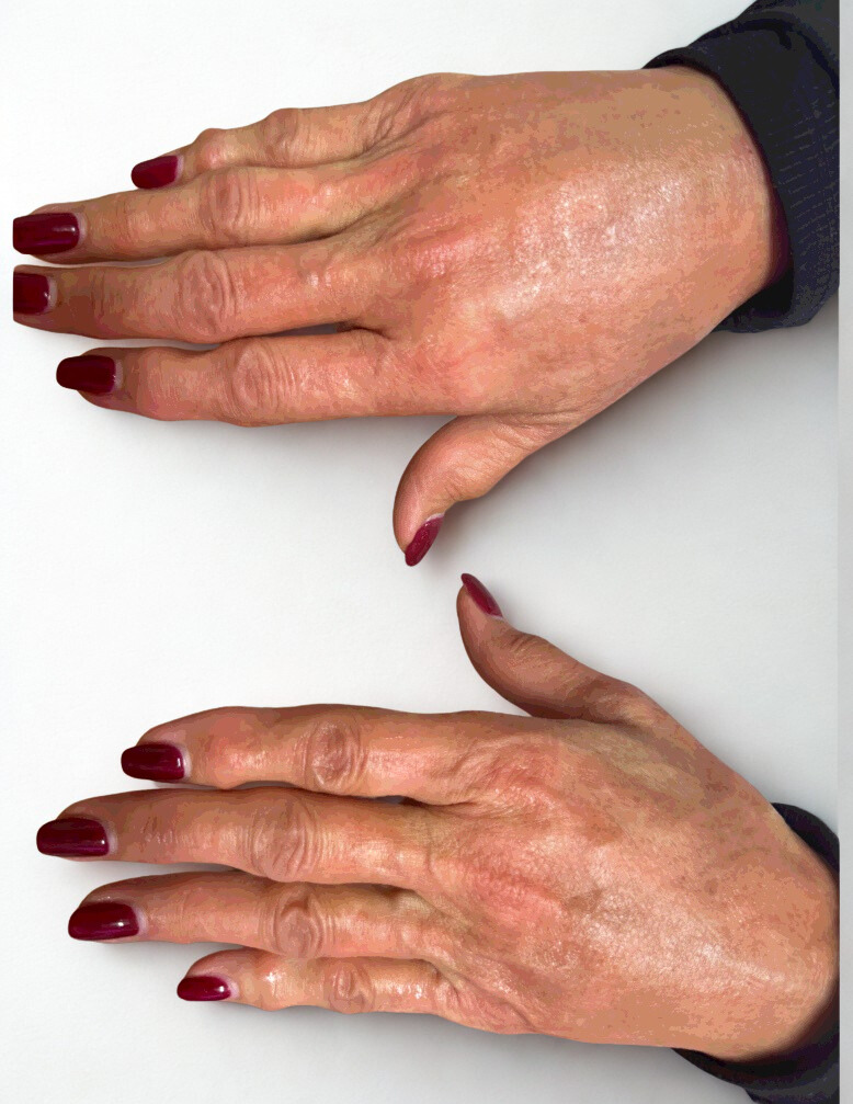 After Image: Hand Sculpt + Firm Procedure - left-side