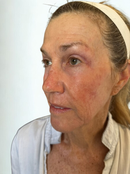 Before Image: DEKA CO2 Laser,Mild Settings - left-front-oblique