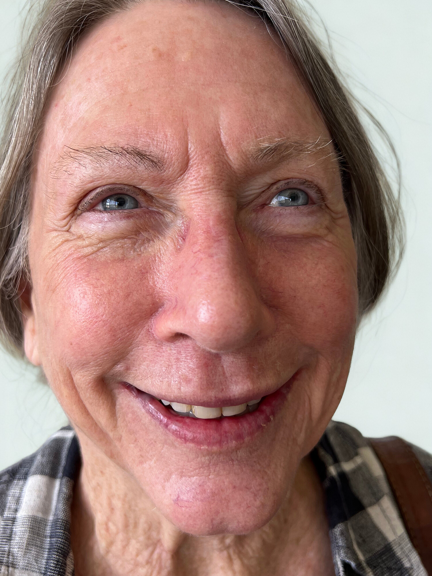 After Image: DEKA CO2 Laser, Facial Balancing - front