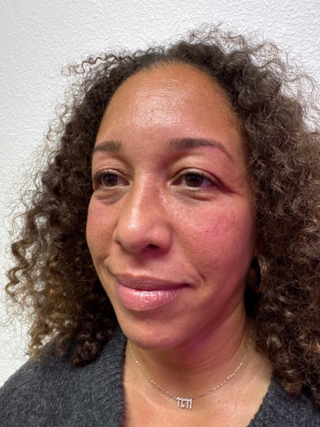 After Image: Cheek Filler - left-front-oblique