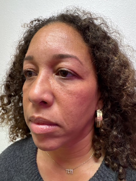 Before Image: Cheek Filler - left-front-oblique