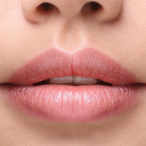 Dermal Filler Treatment, Perfect Lip Re-do Dermal Filler Treatment Perfect Lip Re do