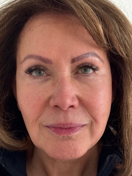 After Image: Facial Balancing - front