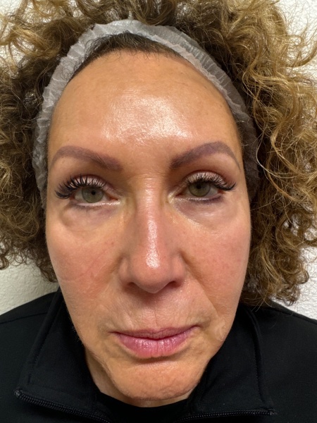 Before Image: Facial Balancing - front