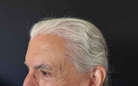 After Image: Hair Restoration - left-front-oblique