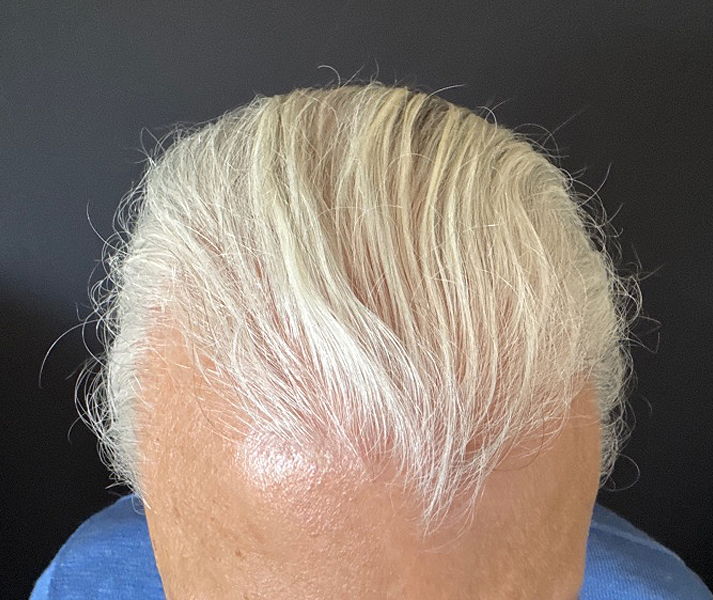 After Image: Hair Restoration - front
