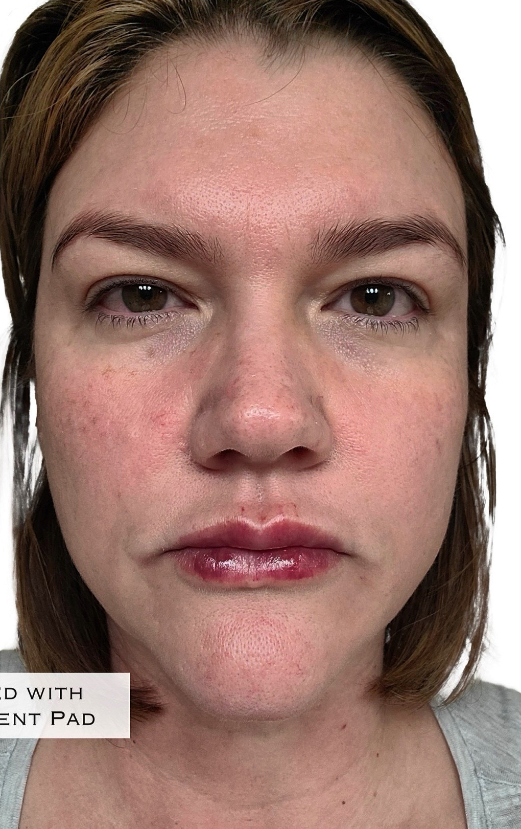 After Image: Lip Filler - front