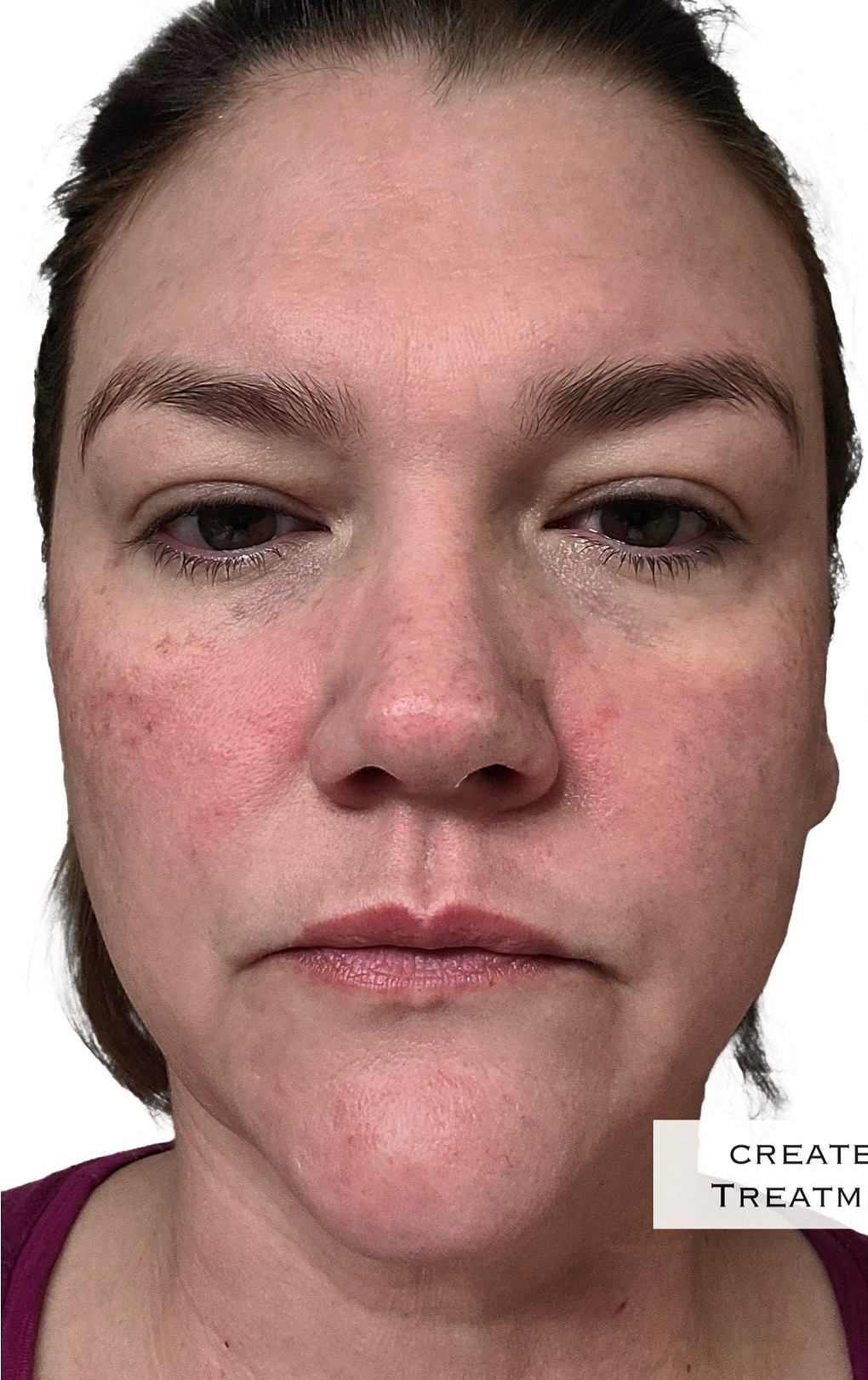Before Image: Lip Filler - front