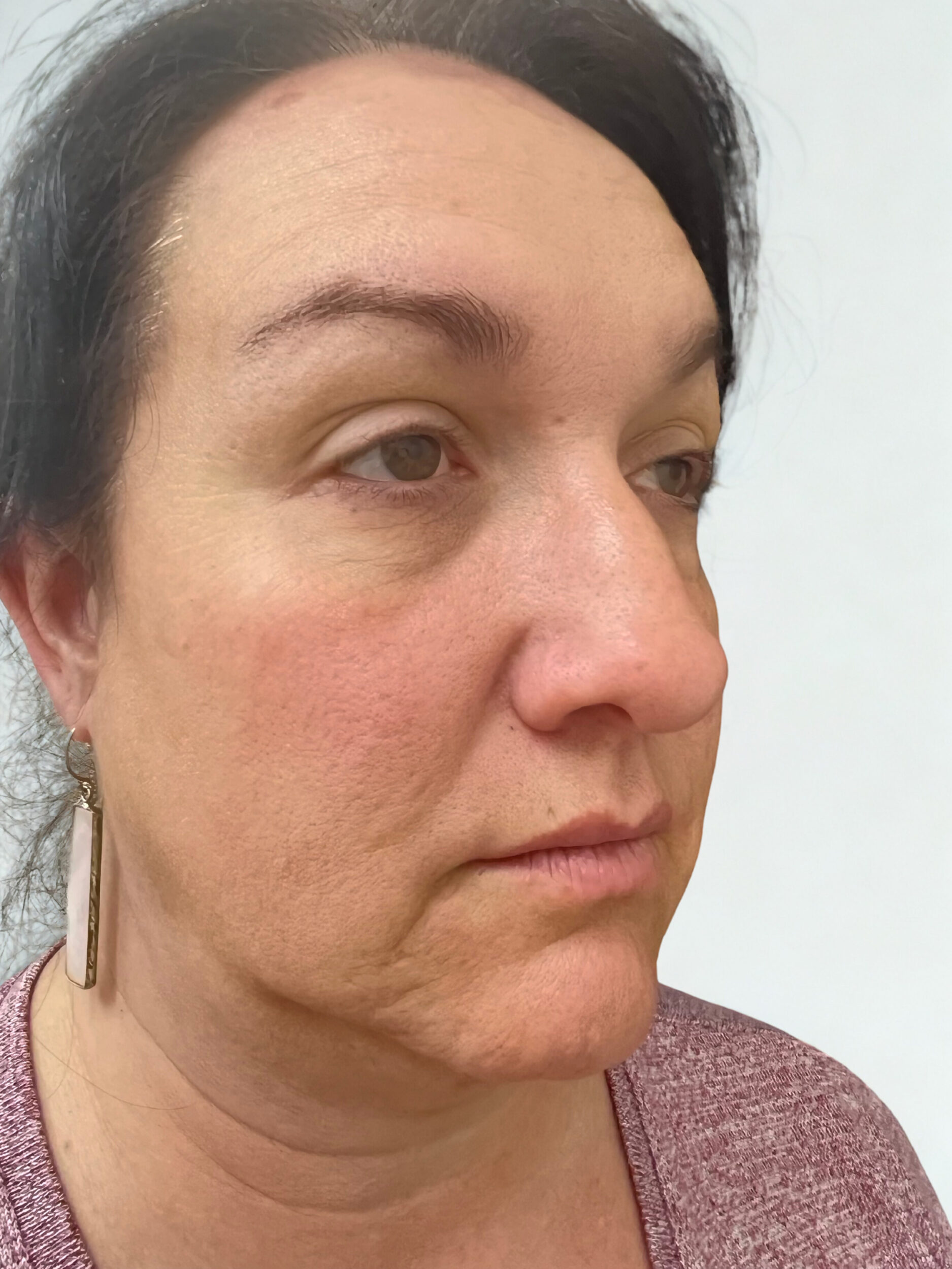 Before Image: Facial Balancing, Biostimulators Face & Neck - right-front-oblique