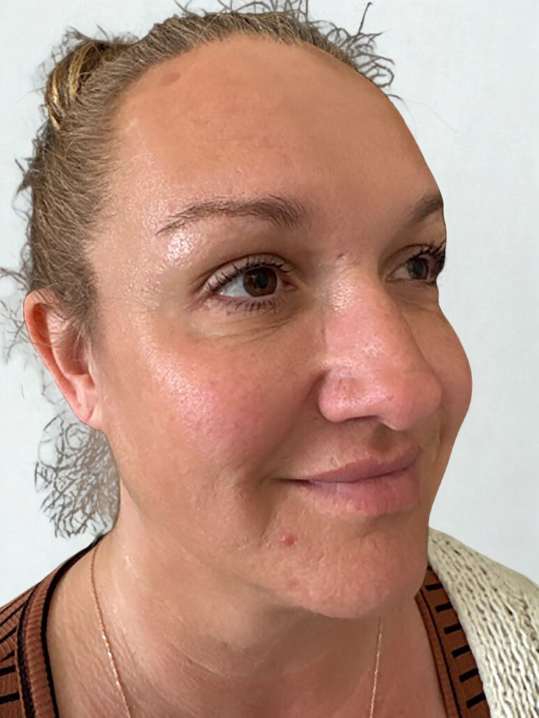 After Image: Facial Balancing, Biostimulators Face & Neck - right-front-oblique
