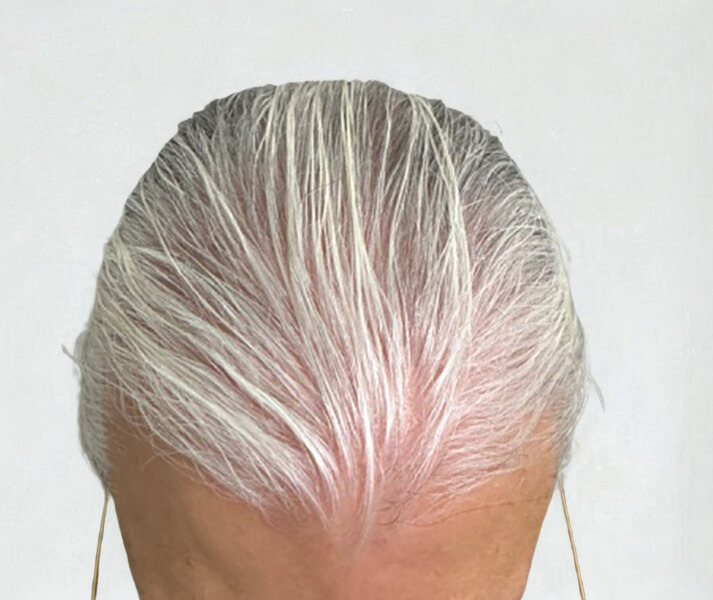 Before Image: Hair Restoration - front