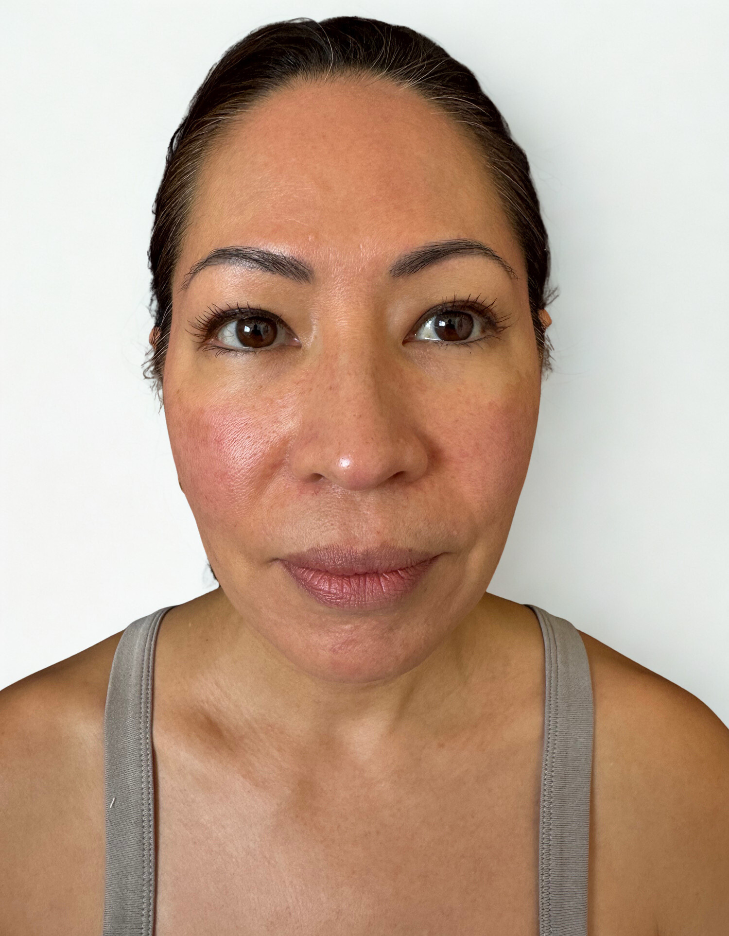 Before Image: Facial Balancing - front