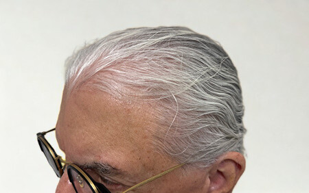 Before Image: Hair Restoration - left-front-oblique