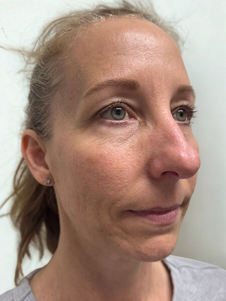 Before Image: Facial Balancing - right-front-oblique