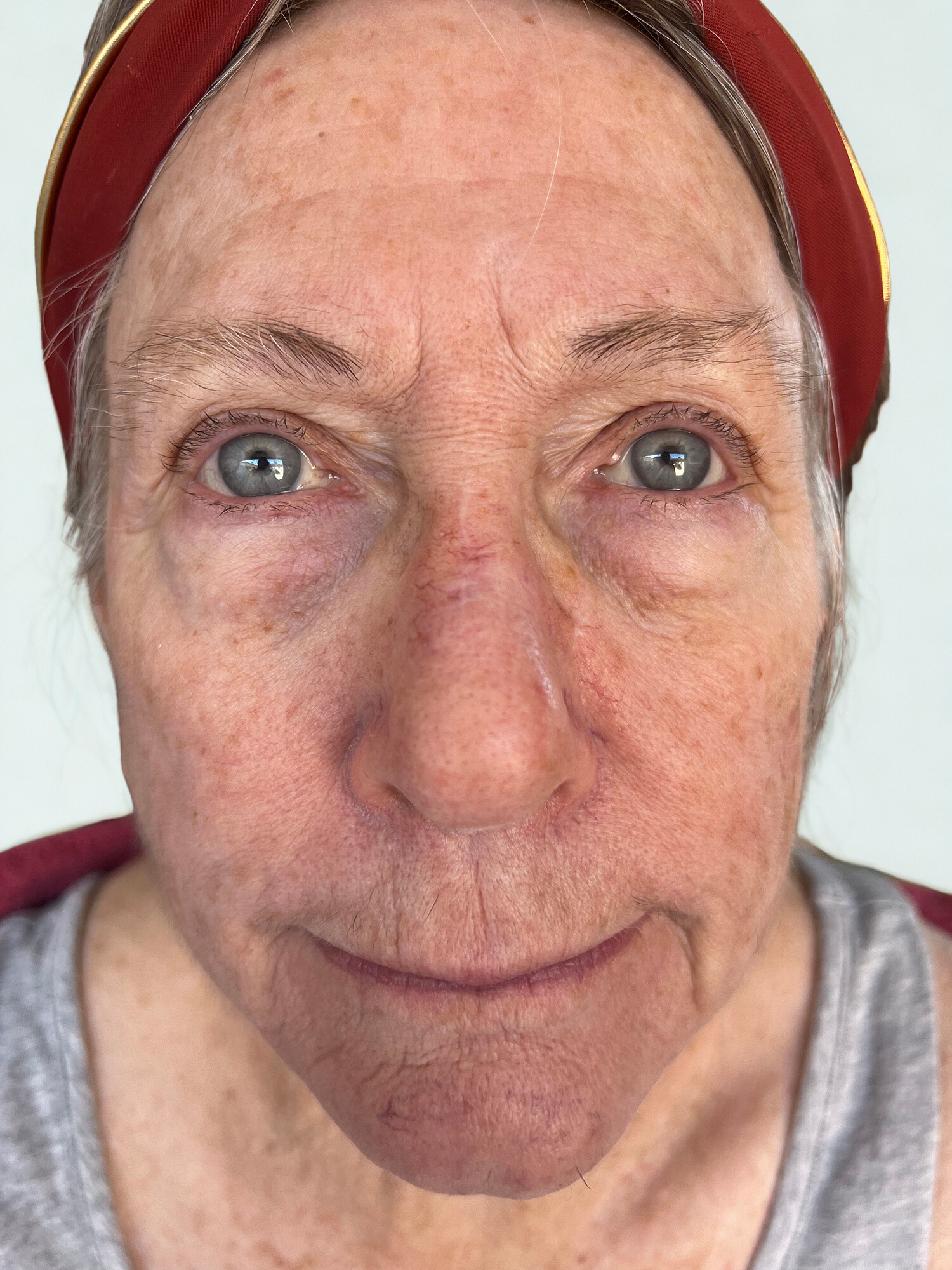 Before Image: DEKA CO2 Laser, Facial Balancing - front