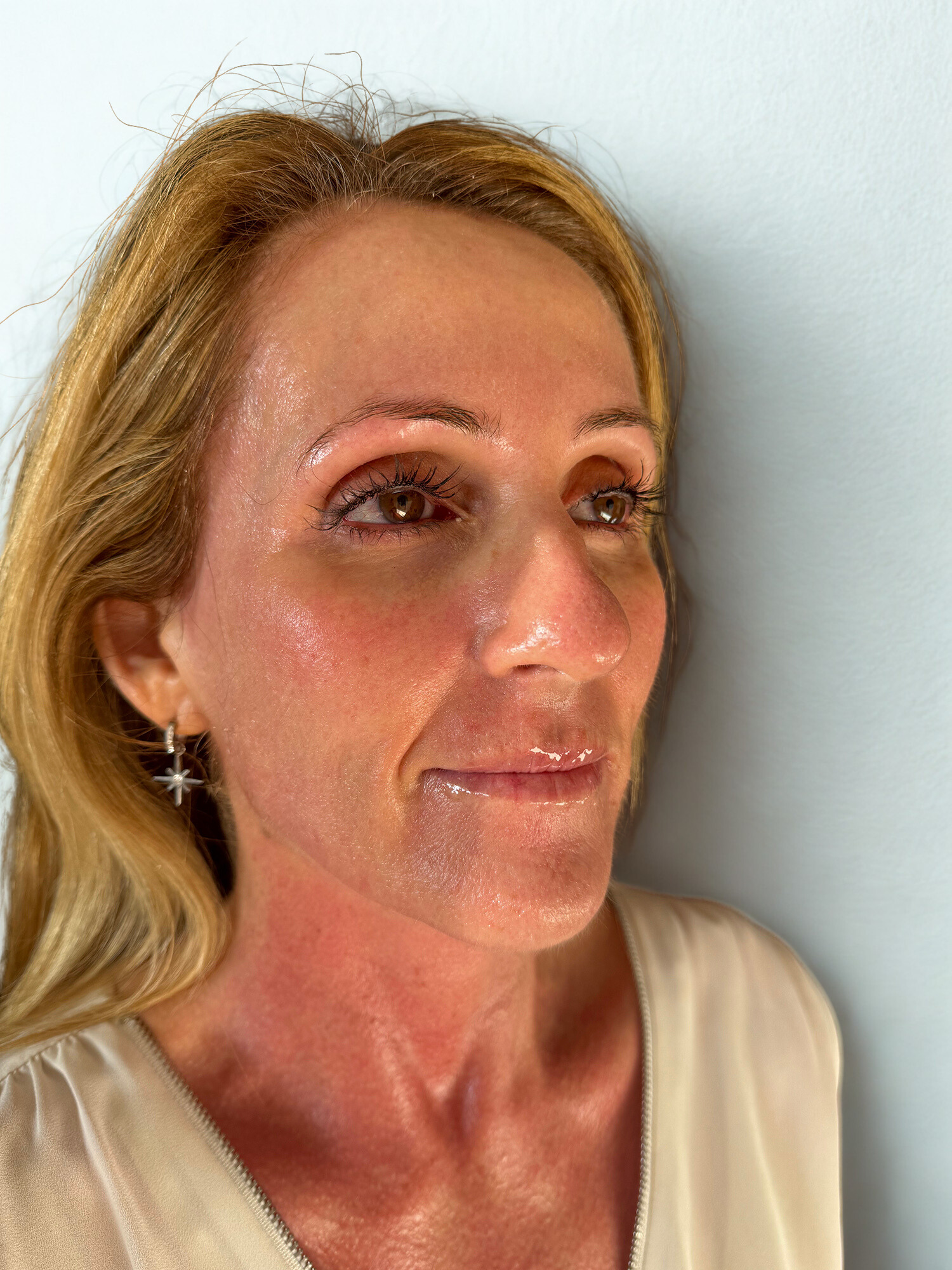 After Image: Biostimulator Treatment Face (Hyperdilute Radiesse), Clear + Brilliant Laser, Sylfirm X Radiofrequency Microneedling - right-front-oblique