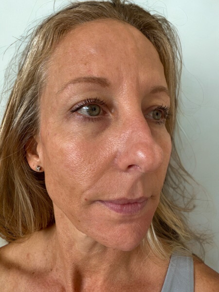After Image: Facial Balancing - right-front-oblique