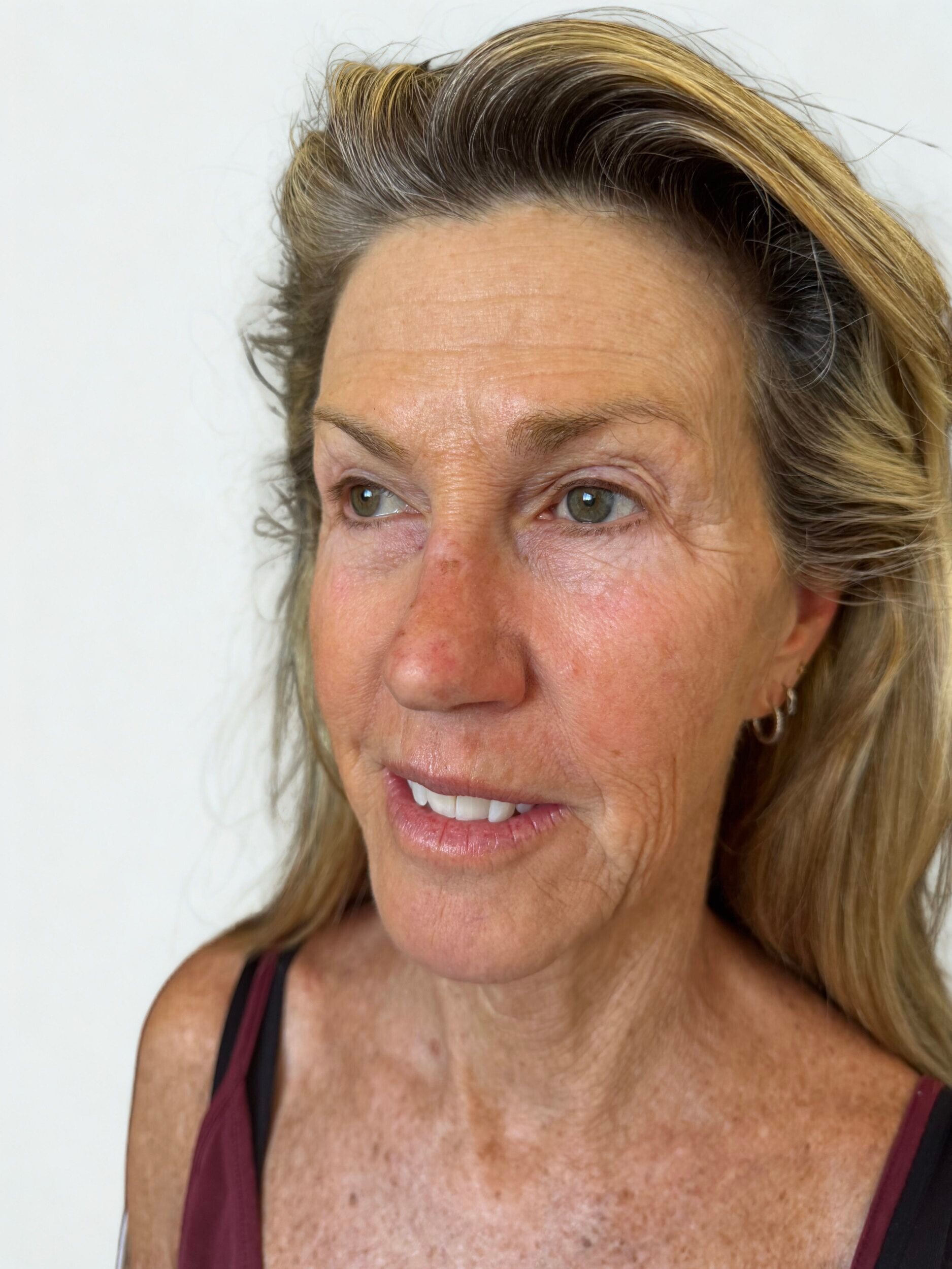 After Image: DEKA CO2 Laser,Mild Settings - left-front-oblique