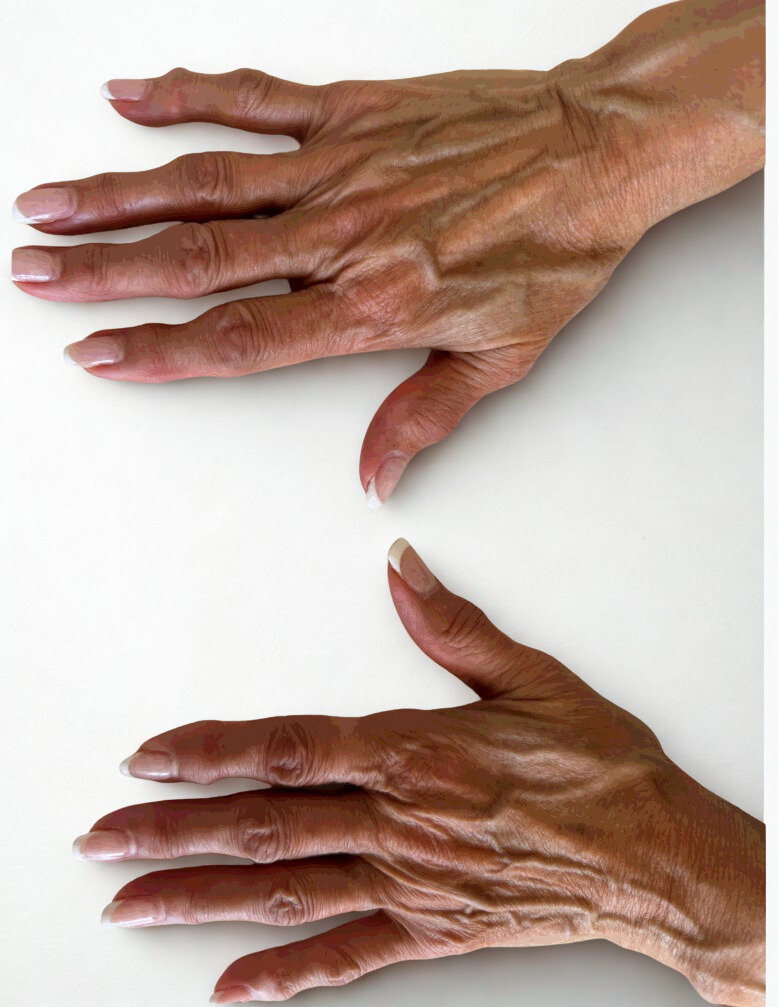 Before Image: Hand Sculpt + Firm Procedure - left-side