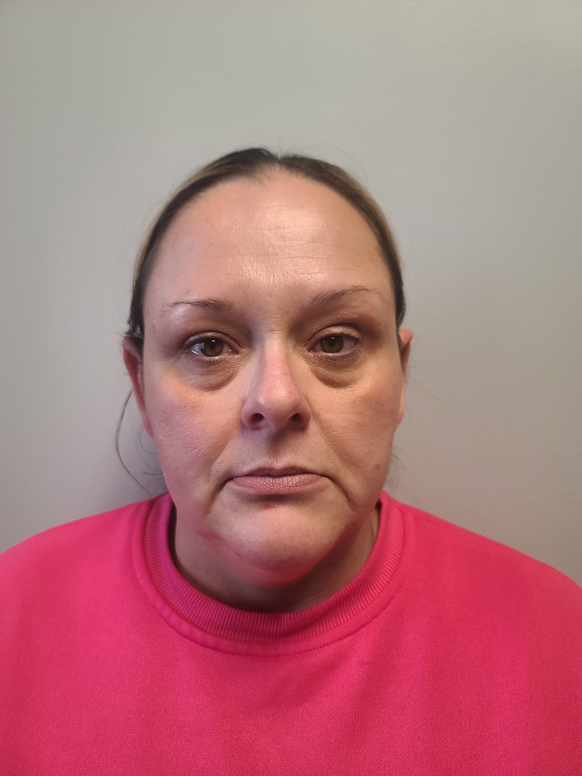 Before Image: Facial Balancing - front